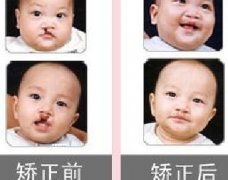 吃兔肉真的會(huì)長(zhǎng)兔唇？為什么會(huì)長(zhǎng)兔唇？